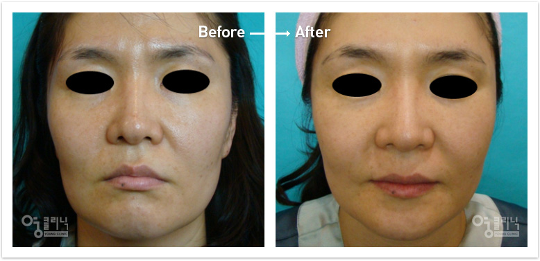 줄기세포 얼굴성형 및 피부재생술 전후사진