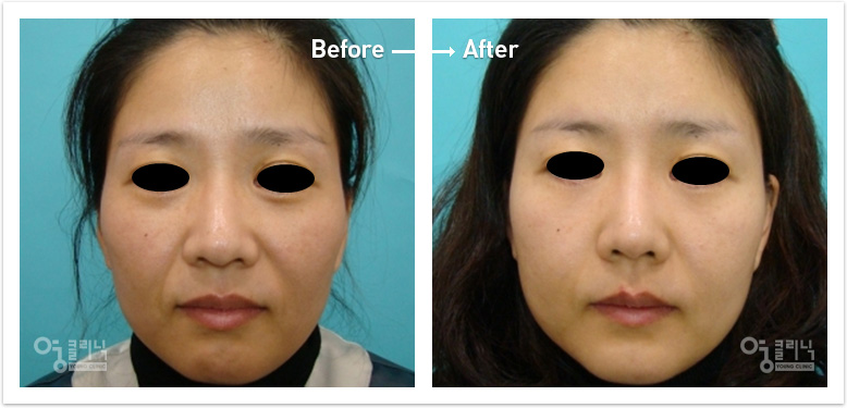줄기세포 얼굴성형 및 피부재생술 전후사진