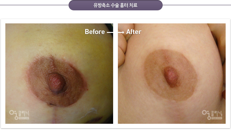 유방축소 수술 흉터 치료 전후사진