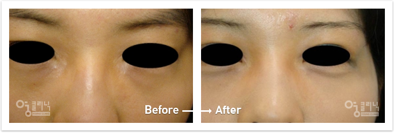 눈 흉터 치료사례 2