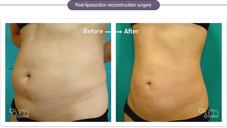 Post-liposuction reconstruction surgery case