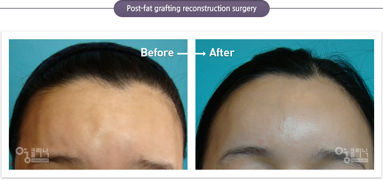 Post-fat grafting reconstruction surgery