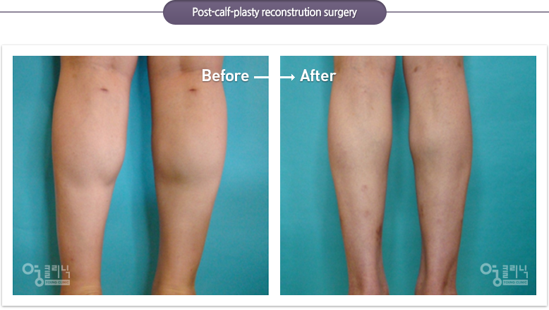Post-calf-plasty reconstrution surgery case