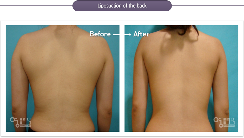 Liposuction of the back
