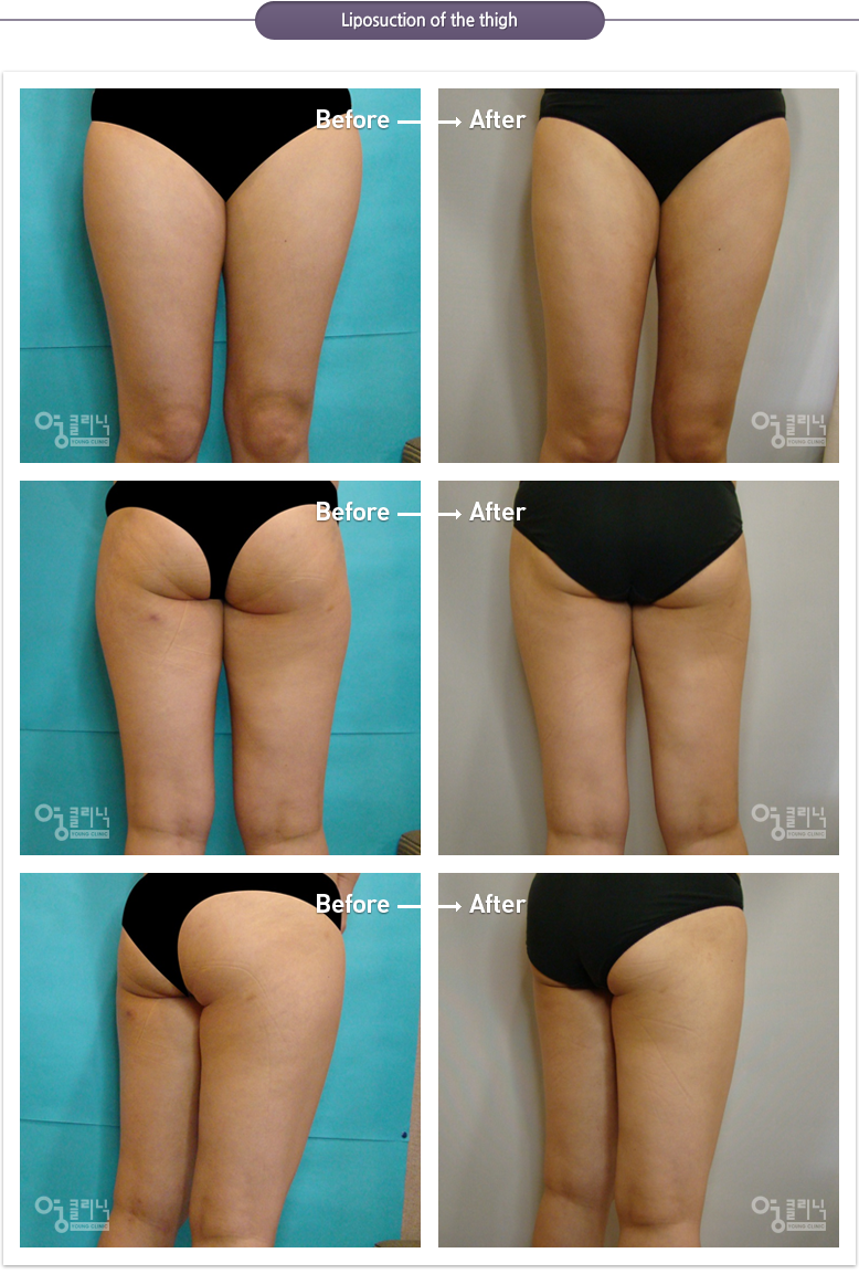 Liposuction of the thigh