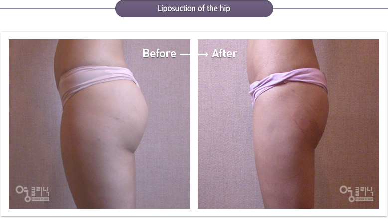 Liposuction of the hip