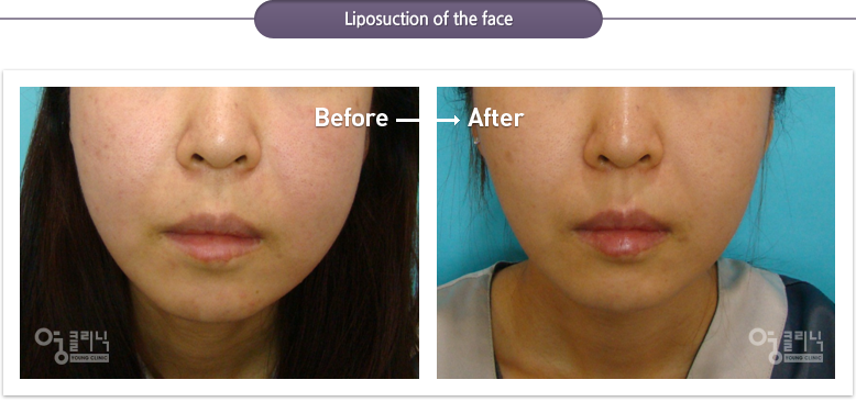 Liposuction of the face