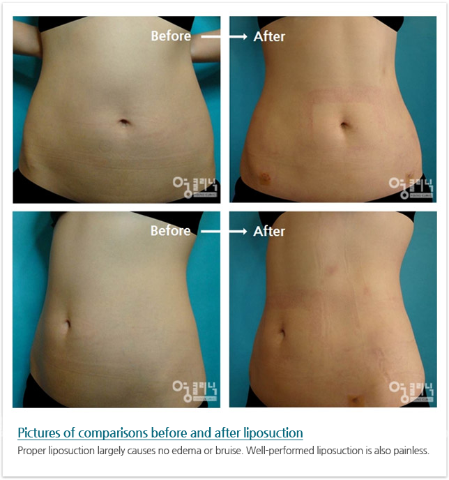 Pictures of comparisons before and after liposuction