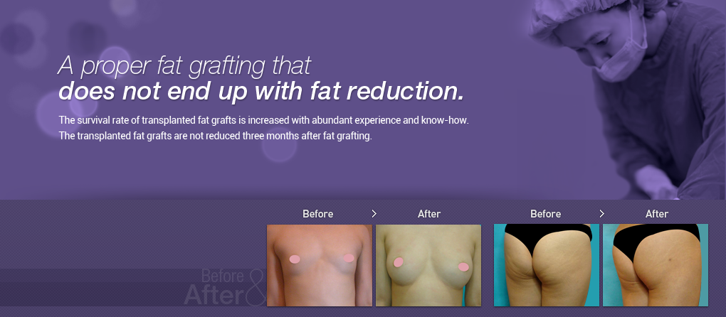 A proper fat grafting that does not end up with fat reduction.