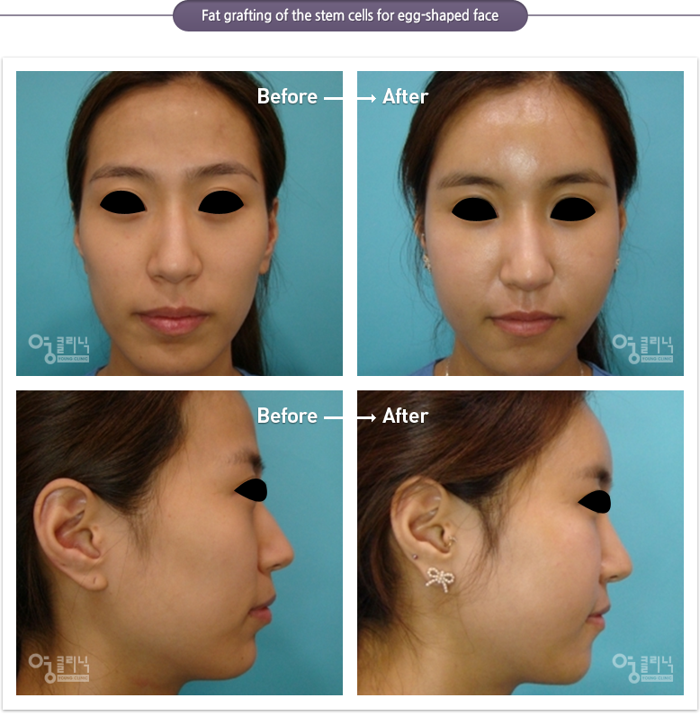 Fat grafting of the stem cells for egg-shaped face