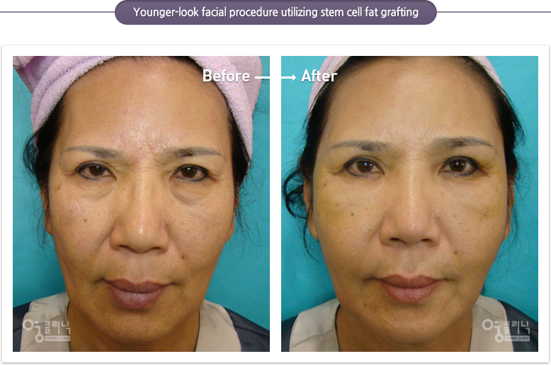 Younger-look facial procedure utilizing stem cell fat grafting
