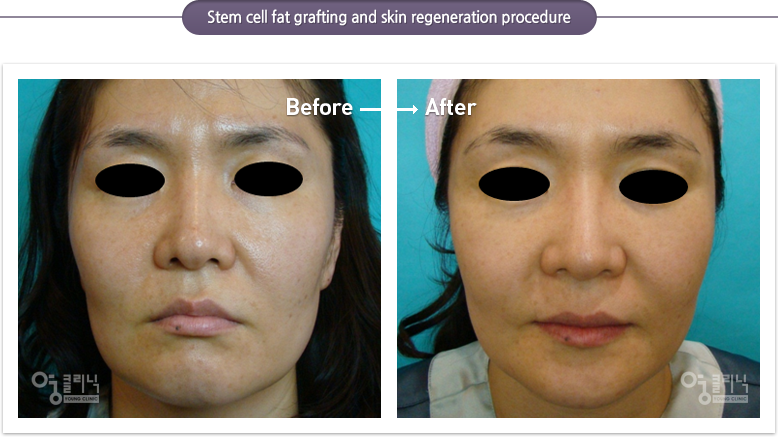 Stem cell fat grafting and skin regeneration procedure