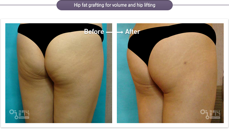 Hip fat grafting for volume and hip lifting