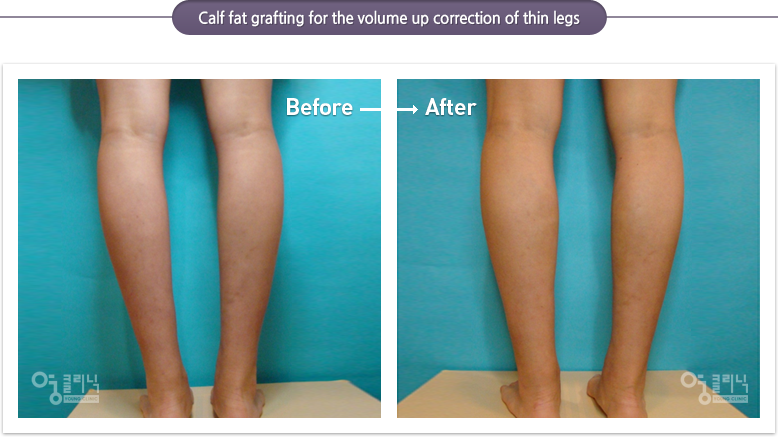 Calf fat grafting for the volume up correction of thin legs