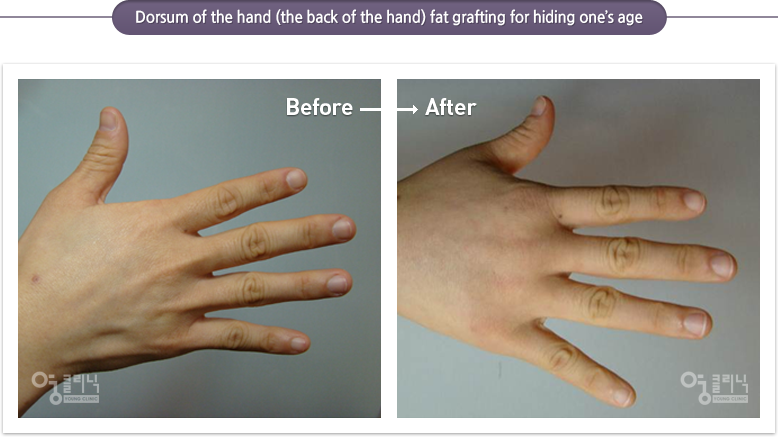 Dorsum of the hand (the back of the hand) fat grafting for hiding one’s age