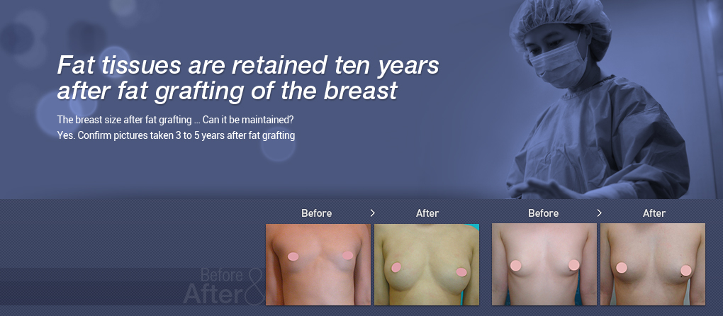 Fat tissues are retained ten years  after fat grafting of the breast