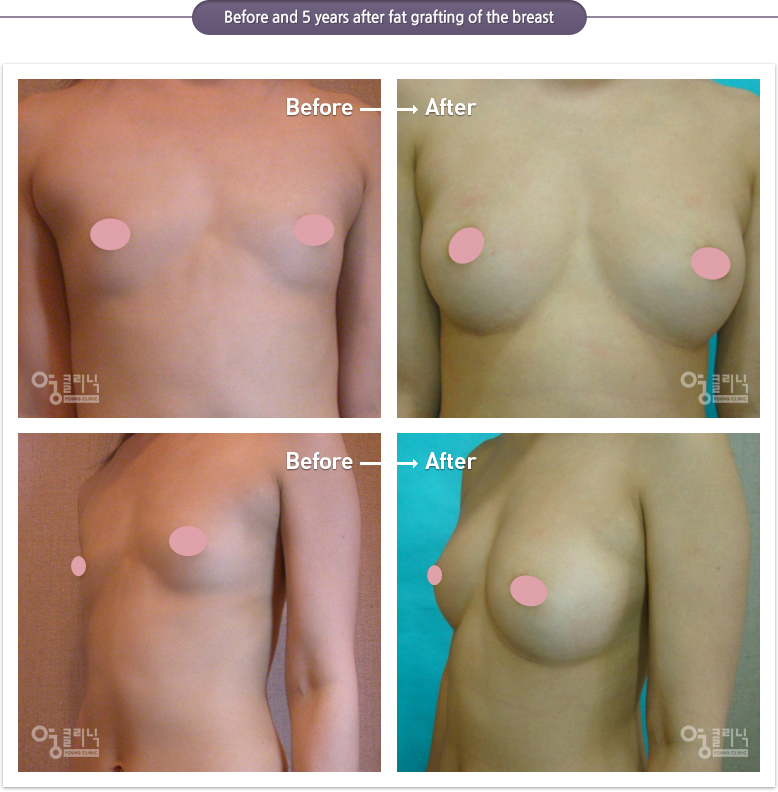 Before and 5 years after fat grafting of the breast