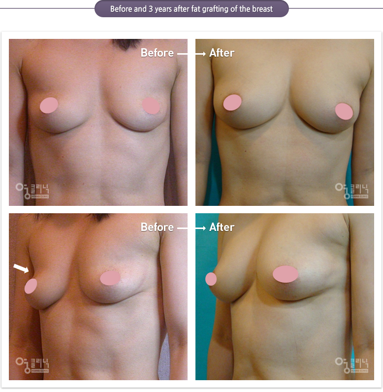 Before and 3 years after fat grafting of the breast