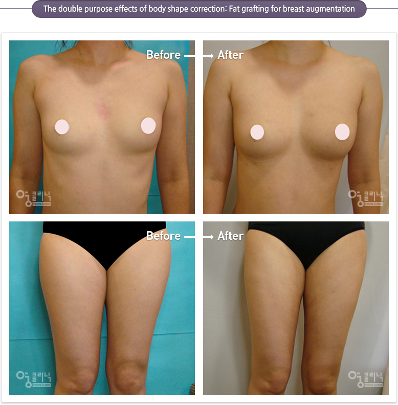 The double purpose effects of body shape correction: Fat grafting for breast augmentation