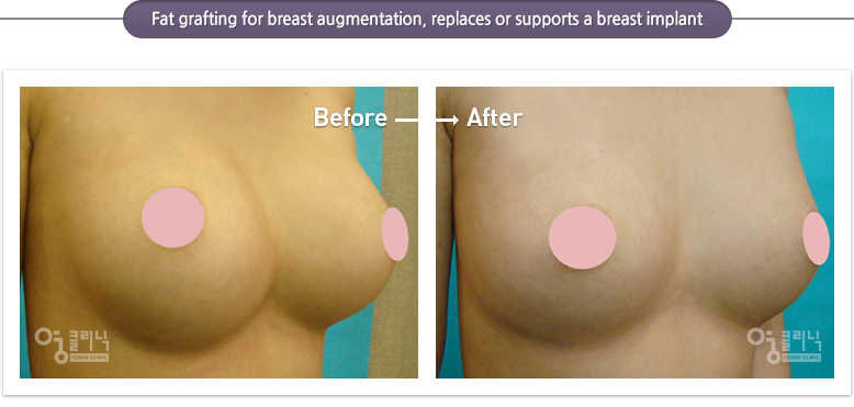 Stem cell breast augmentation that definitely expands