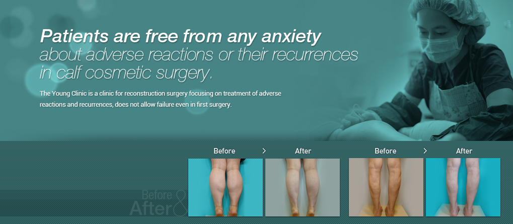 Patients are free from any anxiety 
about adverse reactions or their recurrences 
in calf cosmetic surgery.
