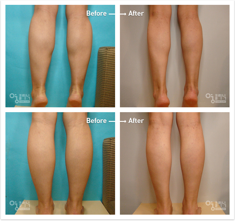 The calf size decreased to 4cm thirteen months after muscle reduction and liposuction