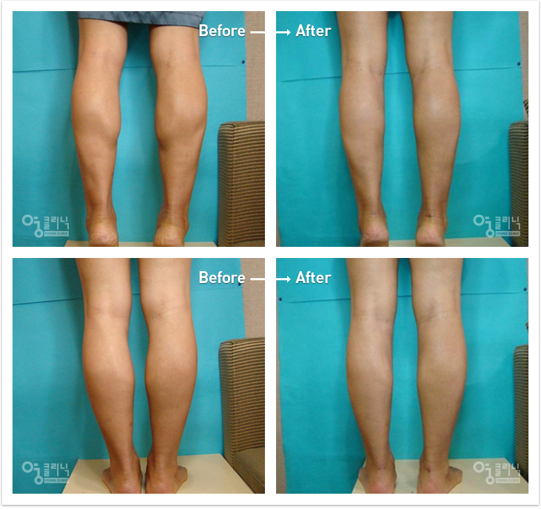 The calf size decreased 2cm three months after muscle reduction, bowed fat grafting and ankle liposuction