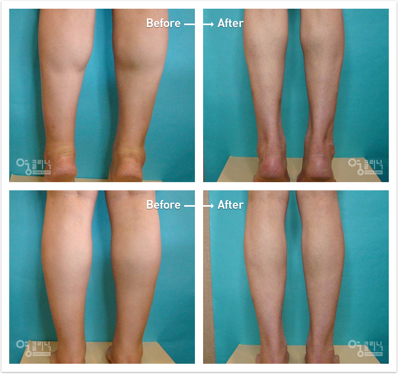 Two years after revision surgery of calfcosmetic surgery