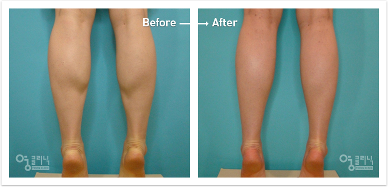 One year after muscle reduction of the calf (multiple denervation)