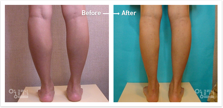 The calf size decreased by 3.5cm six months after liposuction of the calf