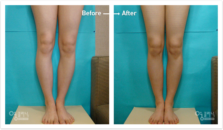 Five months after fat grafting of the bowed legs
